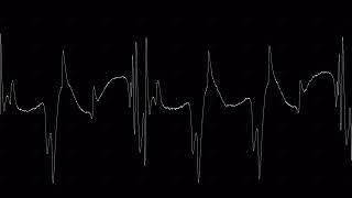 Complex repetitive discharge