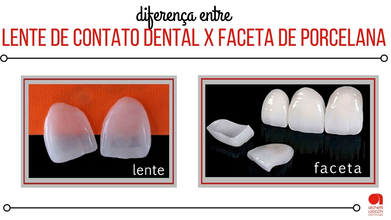 Lente de Contato Dental e Faceta de Porcelana - qual a diferença entre