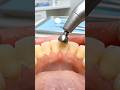 Teeth Whitening Tips At Home ✨✅ #toothcare #oralhealth #youtube #foryou #explore