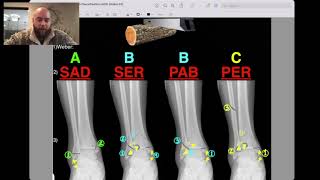 Lauge-Hansen Classification of Ankle Fractures