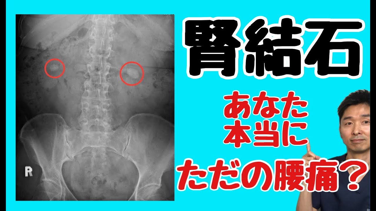 【腎結石】あなたの腰の痛みは本当にただの腰痛ですか?〜腎結石・尿管結石の症状・原因・予防法〜【千葉市の腰痛専門整体院「快」】 - YouTube
