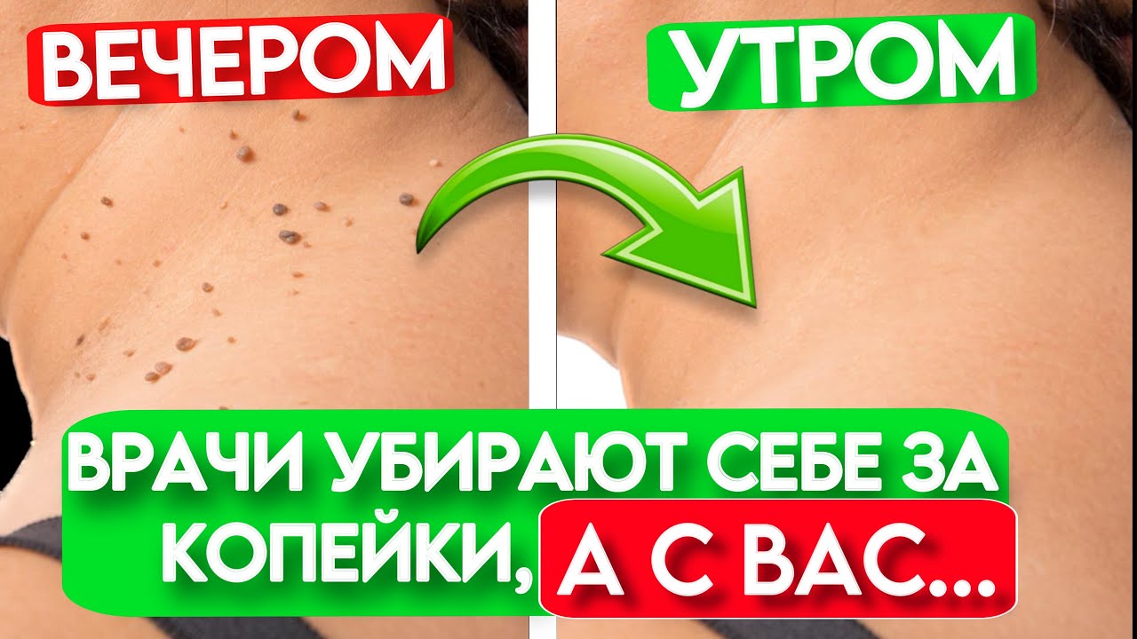 ВРАЧИ СКРЫВАЮТ ЭТОТ МЕТОД! Вот как убрать ПАПИЛЛОМЫ легко и дешево ...