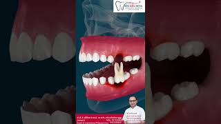 Missing Tooth? Dental Implant vs Dental Bridge | Best Tooth Replacement Option #manojdentalhospital