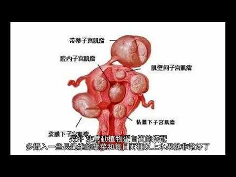 長期喝豆漿真會得子宮肌瘤嗎？