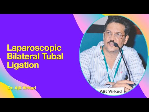 Laparoscopic Bilateral Tubal Ligation