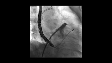 Left atrial appendage opacification for managing thromboembolic risk in atrial fibrillation