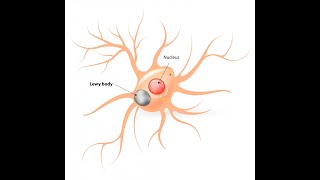 What is the correlation between Lewy bodies and Parkinson’s disease (PD)?