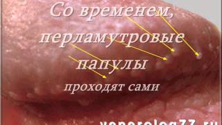 Перламутровые видео Прыщи на члене: виды, причины и лечение высыпаний