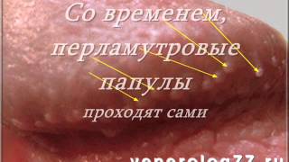 видео Прыщи на члене: виды, причины и лечение высыпаний