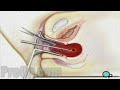 Dilation and Curettage D & C Surgery PreOp® Patient Engagement and Education