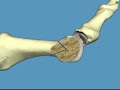 Hallux valgus dr hobeychi podiatre