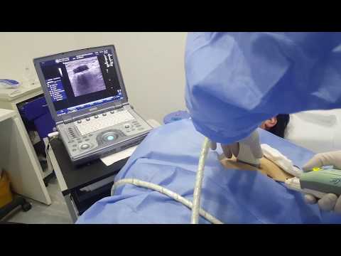 ვაკუუმ რეზექცია - ძუძუს ფიბროადენომის მოცილების ვიდეო