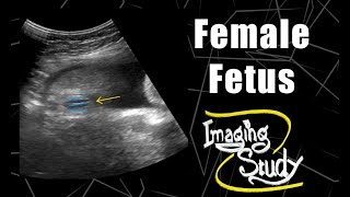 Female Fetus - Its a Girl || Ultrasound || Case 71