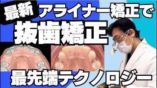 み*ん様 237 アライナー矯正治療 診断/治療計画/矯正治療/顎位整復治療 み*ん様 237 アライナー矯正治療 診断/治療計画/矯正治療/顎位整復