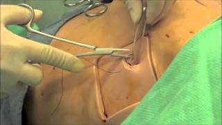 Chest Tube Insertion