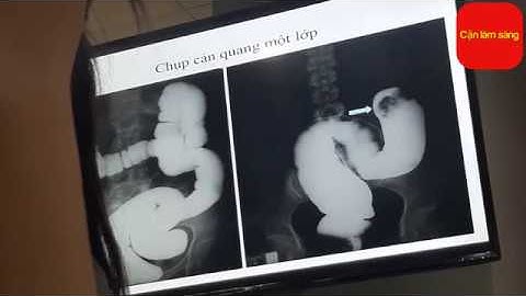 X QUANG TIÊU HÓA CẢN QUANG | BS. AN