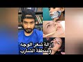 افضل طريقه لإزالة شعر الوجه ومنطقة الشارب - دكتور طلال