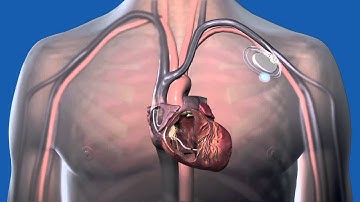 What is a pacemaker ?