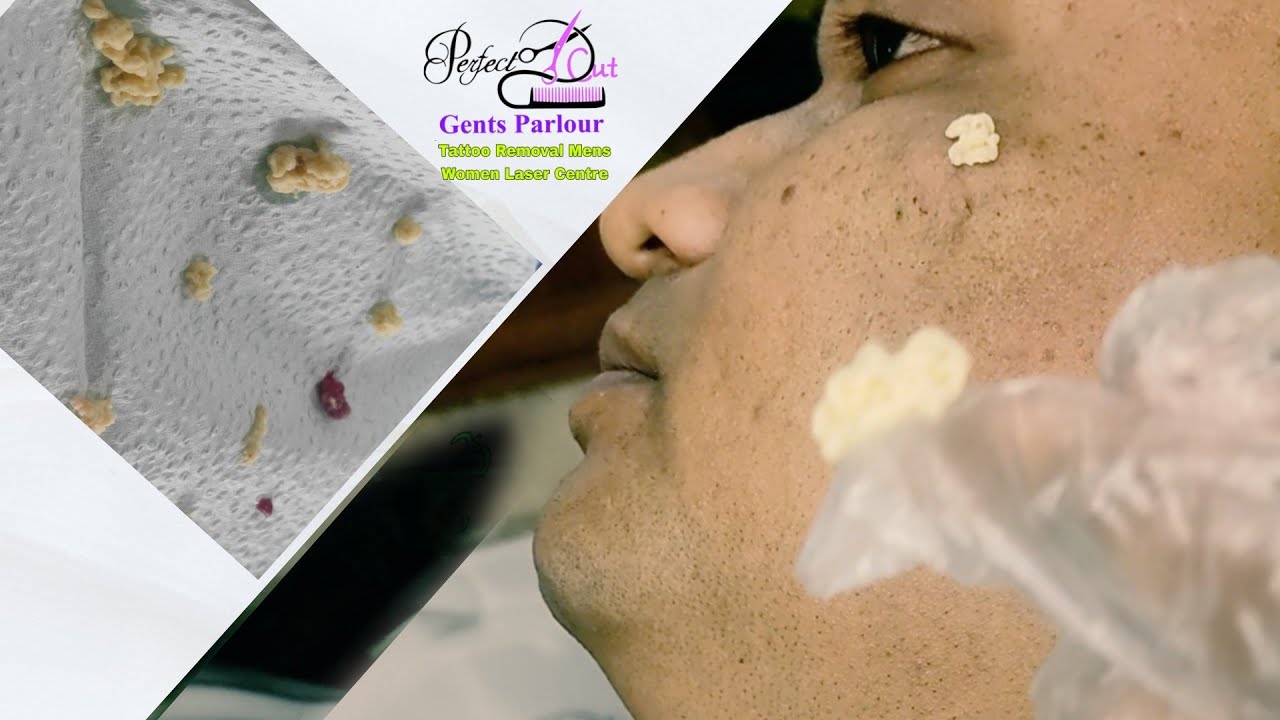 সিবাসিয়াস সিস্ট লেজার ট্রিটমেন্ট Sebaceous cyst laser treatment acne