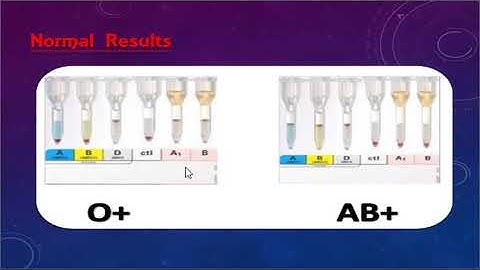 ABO discrepancy and transfusion practice part one By Dr. Mohamed Samir