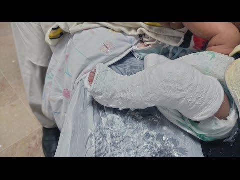 club foot serial cast A Game-Changer in the Treatment of Clubfoot'