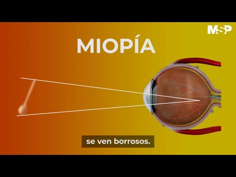 Video: ¿Las computadoras causan miopía?