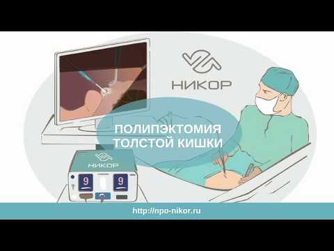 Полипэктомия толстой кишки