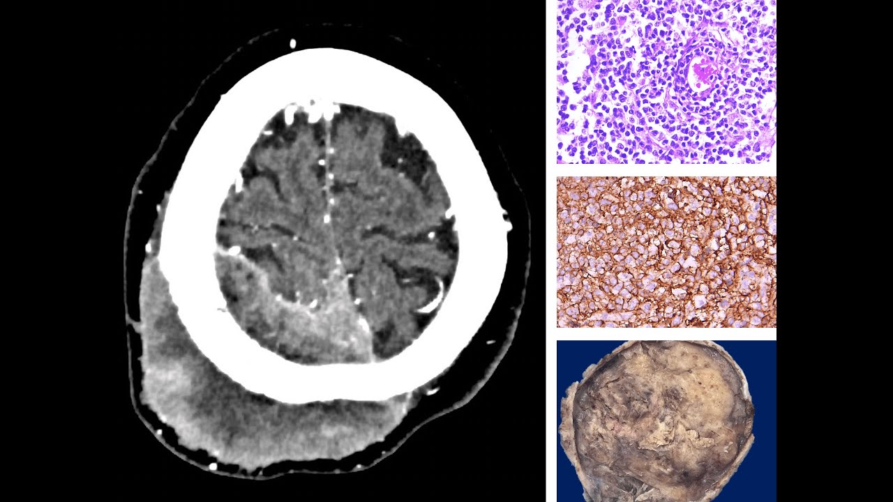 LINFOMA DURAL PRIMARIO | LINFOMA B DIFUSO DE CEL. GRANDES | NEUROPATOLOGÍA | IMSS | UNAM | SECIHTI