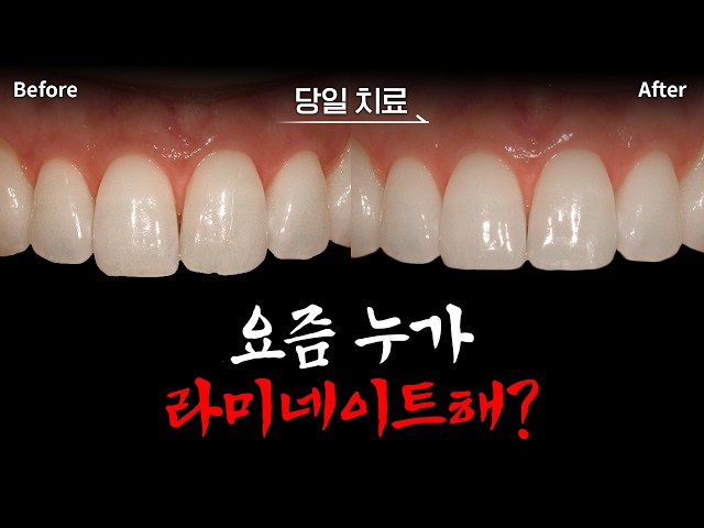 ❌라미네이트 안 했습니다 | 치아 끝, 길이만 다듬을 수 있다?!