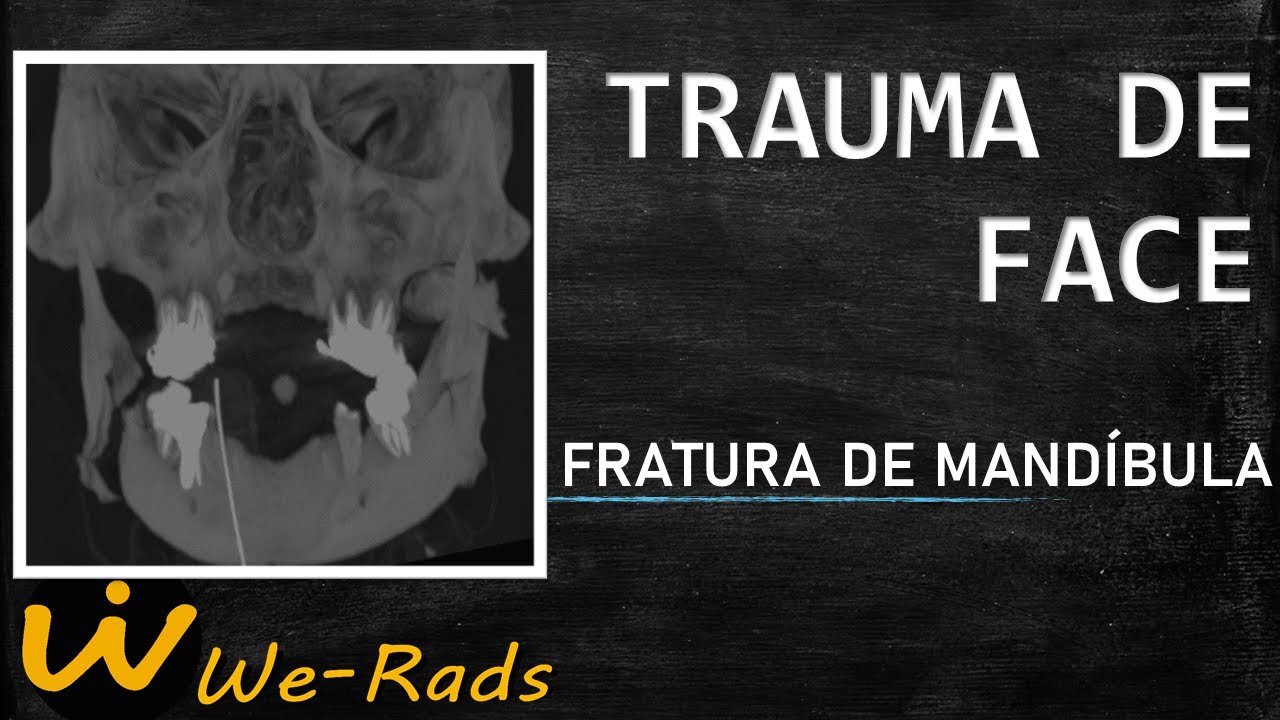 TRATAMENTO PARA Fratura Mandibular