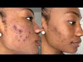 CLEARING UP ACNE SCARRING & HYPERPIGMENTATION!