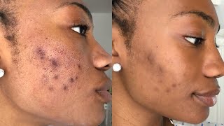 I recently had a session of micro needling & chemical peel to improve
my acne scarring and hyper pigmentation caused by recent brief break
out. talk...