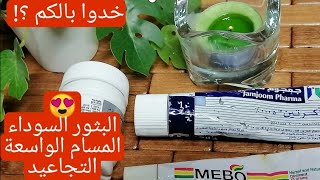 العلاج المثالي والحل النهائي لحب الشباب وحبوب تحت الجلد والبقع وتقشير البشرة كريم أكرتين