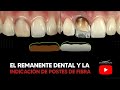 El remanente dental y la indicación de postes de fibra