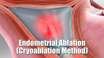 Endometriumablatie (cryoablatiemethode)