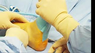 Portal for ankle arthroscopy