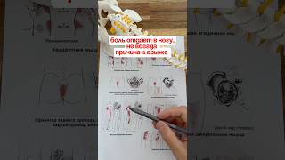 Боль отдает в ногу.Триггеры .Миопрессура.Грыжа диска . #лечение #триггеры #миопрессура #грыжа