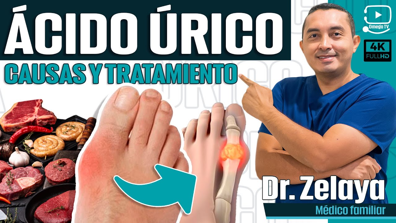 ACIDO URICO ¿Por qué se eleva?, sintomas y tatamiento Doctor Zelaya