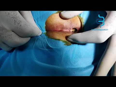 علاج الناسور العصعصي   