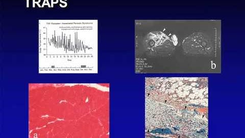 The Autoinflammatory Syndromes: All Who Fever Are Not Infected