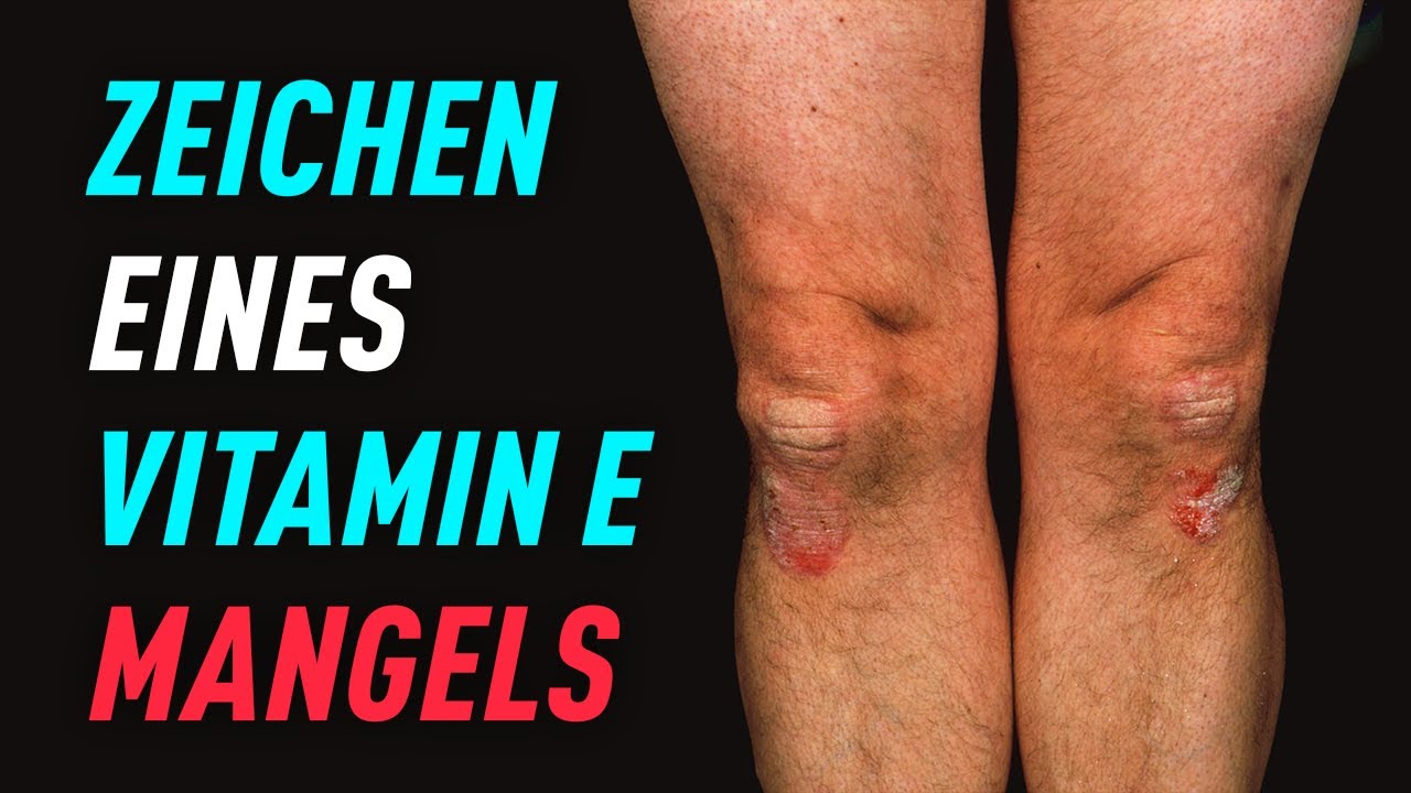 Vitamin E Mangel Symptome Frau