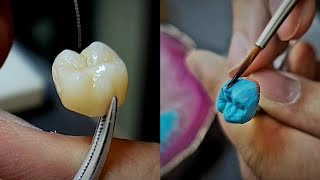 molar build_up (one bake )...بناء الخزف لرحى أولى علوية بتقنية الخبزة الواحدة