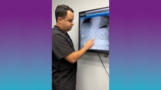 Nevro's Spinal Cord Stimulator on X-ray – Precision Implantation for Optimal Results