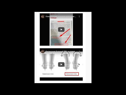 Вальгусная стопа как писать рапорты перед ВВК