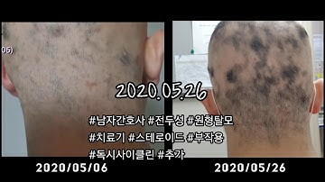 남자 간호사 전두성 원형탈모 치료기 - 스테로이드 부작용|독시사이클린|