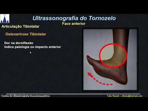 Vídeo: Capacidade Diagnóstica Da Avaliação Ultra-sonográfica Dinâmica Das Lesões Do Tornozelo Por Supinação-rotação Externa: Um Estudo Cadavérico