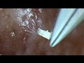 【No.6】角栓連続抜き!I pulled out a lot of keratin plug