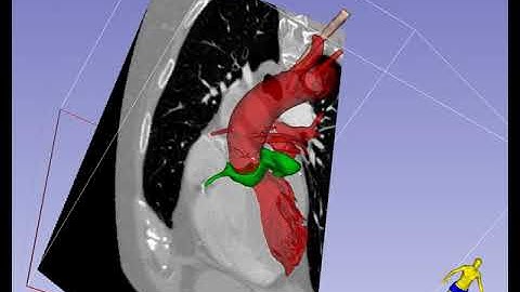 Deep Transgastric Long-Axis Imaging Plane in TEE - En Face View