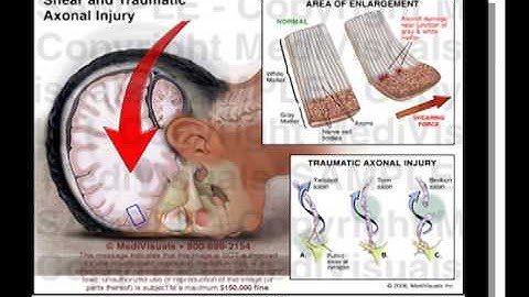 Getting to Work After a Traumatic Brain Injury Part 1 - By Nathan Zasler