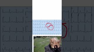 De Winter Pattern: The STEMI Equivalent You Must Not Miss